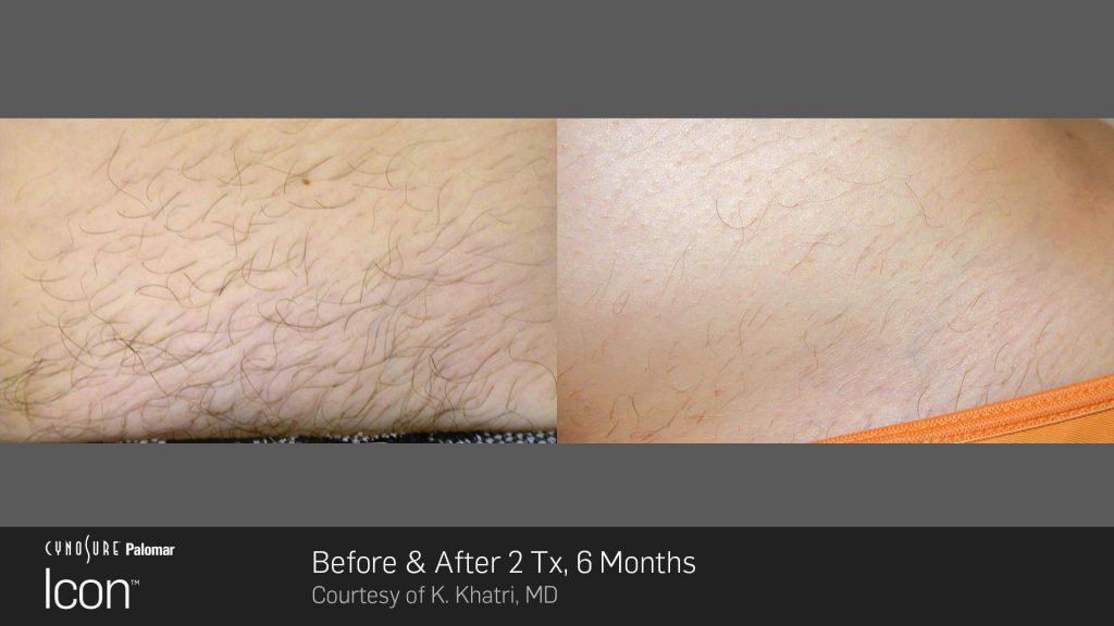 Before and after results for laser hair removal