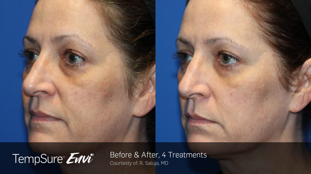 Before and after TempSure Envi results