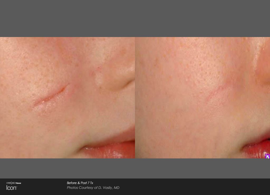 Before and after skin resurfacing results