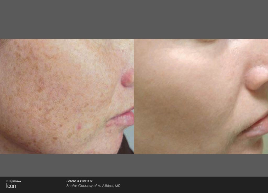 Before and after Icon treatments