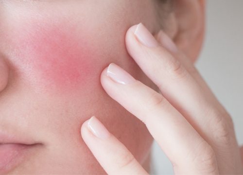 Woman's face with rosacea