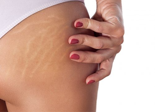 Stretch marks on a woman's body